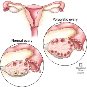 Normal and polycystic ovaries